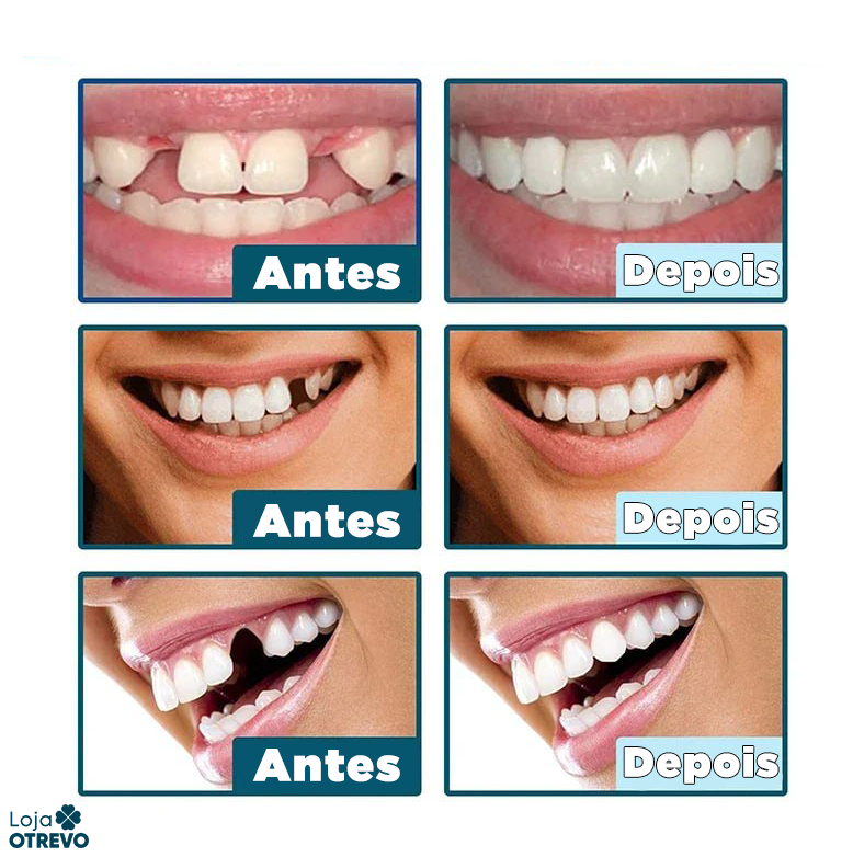 SmileFit® - Facetas Dentárias Naturais Removíveis