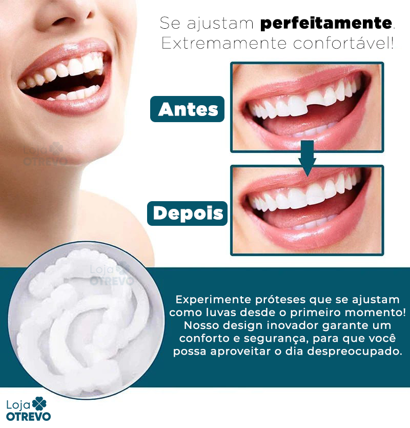 SmileFit® - Facetas Dentárias Naturais Removíveis